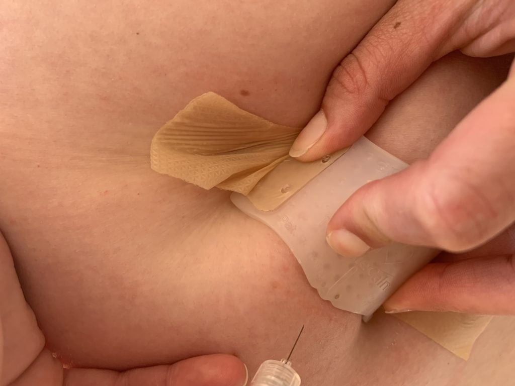Patient using NeedleCalm device to reduce pain during Clexane injection at home